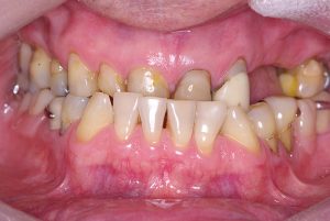 1-Vista inicial intra oral