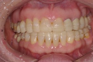 4-overlay-na-boca-com-a-dvo-restabelecida-e-comprimento-dos-dentes-provisoriamente-aumentados