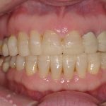4-Overlay na boca com a DVO restabelecida e comprimento dos dentes provisoriamente aumentados