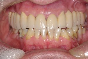 8-Vista final da Reabilitacao Oral finalizada