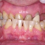1-Vista inicial intra oral