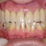 8-Vista final da Reabilitacao Oral finalizada