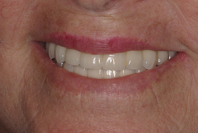 Implantes Dentários em Fortaleza