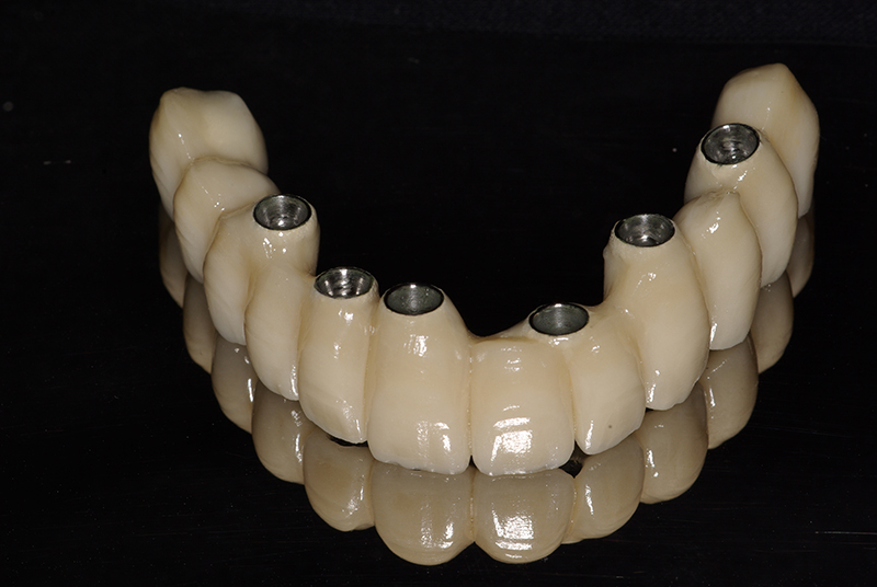 Implantes dentários em fortaleza